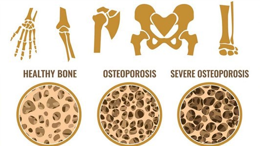 mk677 for bone density