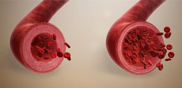 Vasodilation Vasodilation