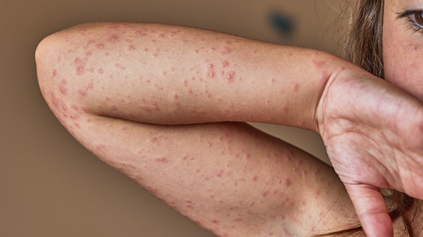 Tirzepatide Side effects--Injection Site Reactions Tirzepatide Side effects--Injection Site Reactions