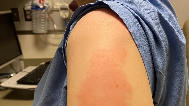 Injection site reactions Injection site reactions