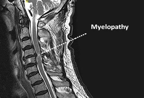 Multiple myelopathy Multiple myelopathy