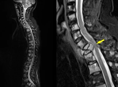 Multiple myelopathy Multiple myelopathy