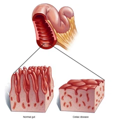 Celiac-Disease Celiac-Disease