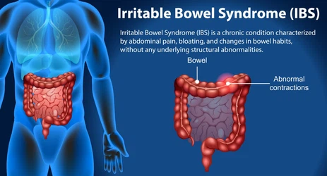 Irritable Bowel Syndrome Irritable Bowel Syndrome