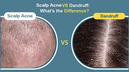 76CB0301 powder A 76CB0301 powder A