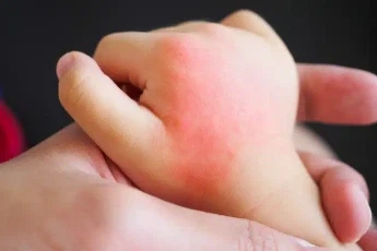 Allergy Reactions