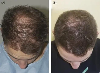 CB0301-hair-loss-in-man CB0301-hair-loss-in-man